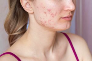 O melhor Tratamento natural para acne